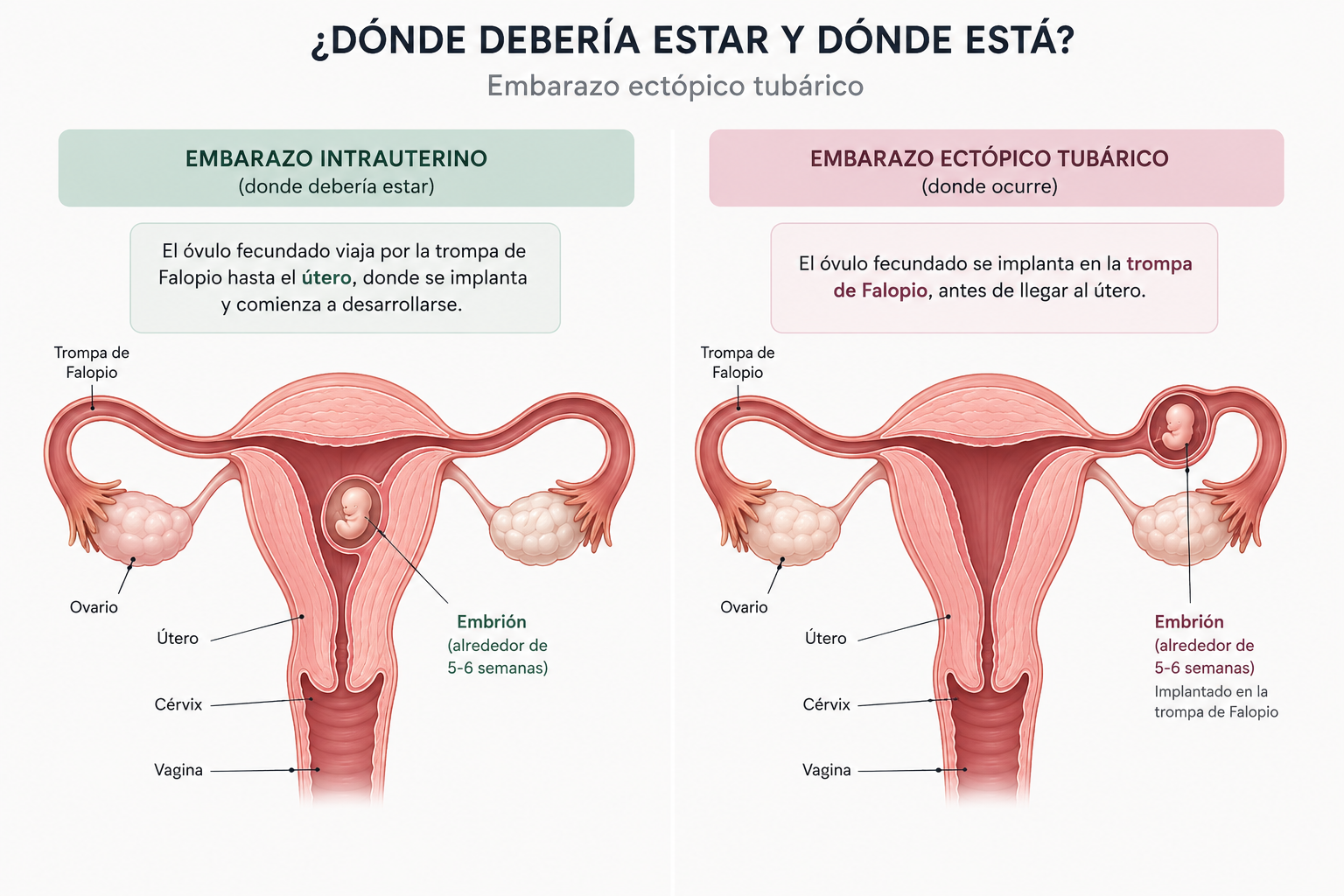 Comparación ilustrada entre un embarazo intrauterino, con el embrión implantado en el útero, y un embarazo ectópico tubárico, con el embrión implantado en la trompa de Falopio.